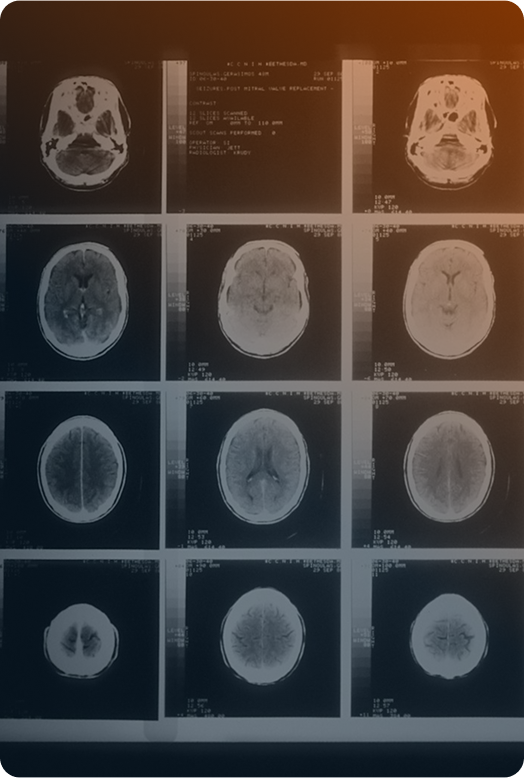 Connecticut brain injury lawyer – LA LAW helps victims of traumatic head injuries