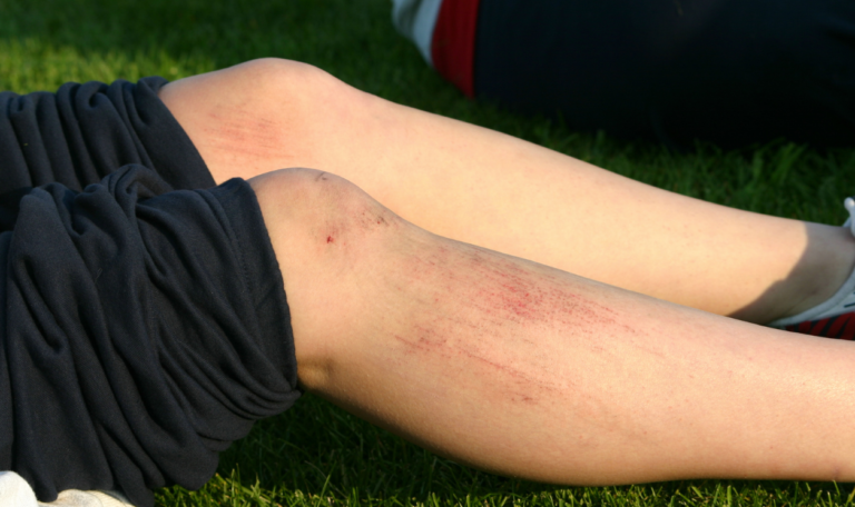 Close-up of minor road rash injuries on a person’s knees and shins after a fall, showing red abrasions on light skin while resting on grass.