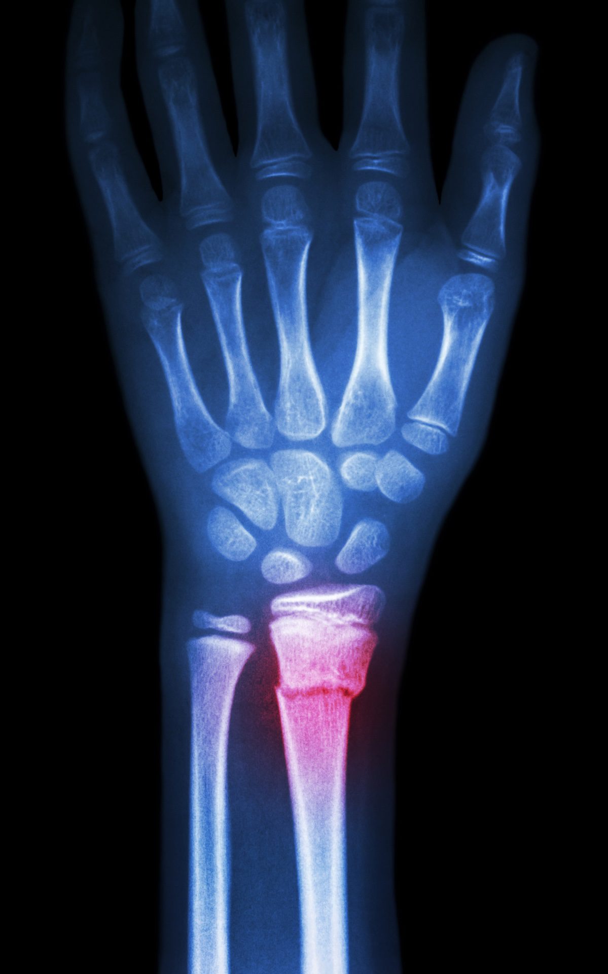 Broken Bone Injury Lawyer Connecticut examining X-ray of fractured wrist after an accident