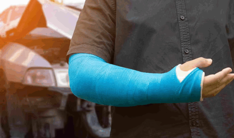 Close-up of an adult with a forearm cast, representing broken bone injury cases handled by L.A. LAW in Hartford and Connecticut.