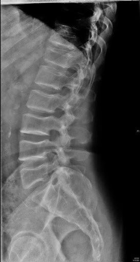 Spinal Injury Lawyer Connecticut providing legal help to victims